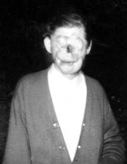 Raymond Robinson, known as Charlie No Face.